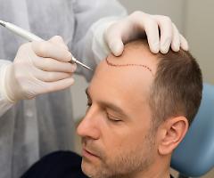 Il trapianto di capelli: soluzioni moderne per ritrovare fiducia e benessere