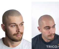 Tricopigmentazione: di cosa si tratta e quali sono i vantaggi rispetto al trapianto di capelli?
