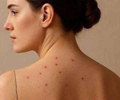 Acaro Sarcoptes scabiei: come vive, come infesta la pelle e perché può diventare un problema anche in casa