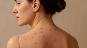 Acaro Sarcoptes scabiei: come vive, come infesta la pelle e perché può diventare un problema anche in casa