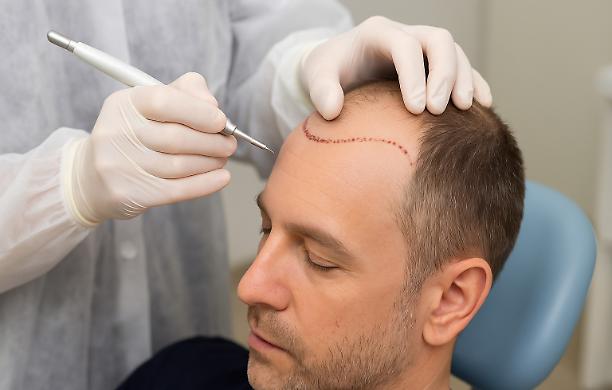 Il trapianto di capelli: soluzioni moderne per ritrovare fiducia e benessere