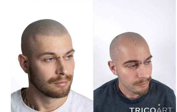 Tricopigmentazione: di cosa si tratta e quali sono i vantaggi rispetto al trapianto di capelli?